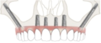 Implantes Dentales Cute Smile Clinic